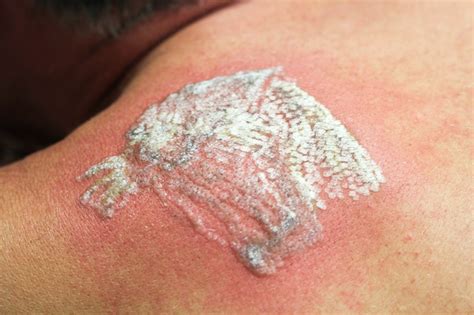 laser tattoo removal infection treatment.